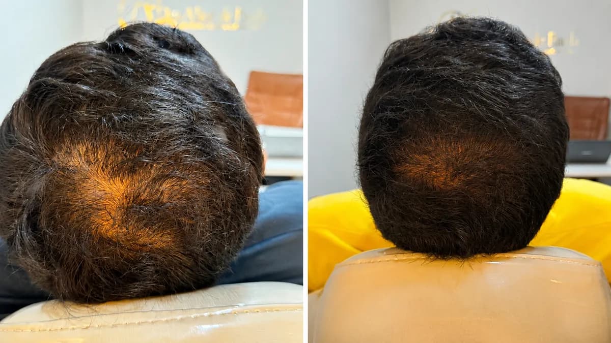 Mesoterapia capilar